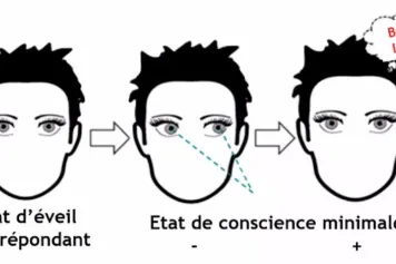 Patients en « état végétatif » : une nouvelle piste pour réussir à évaluer leur niveau de conscience 