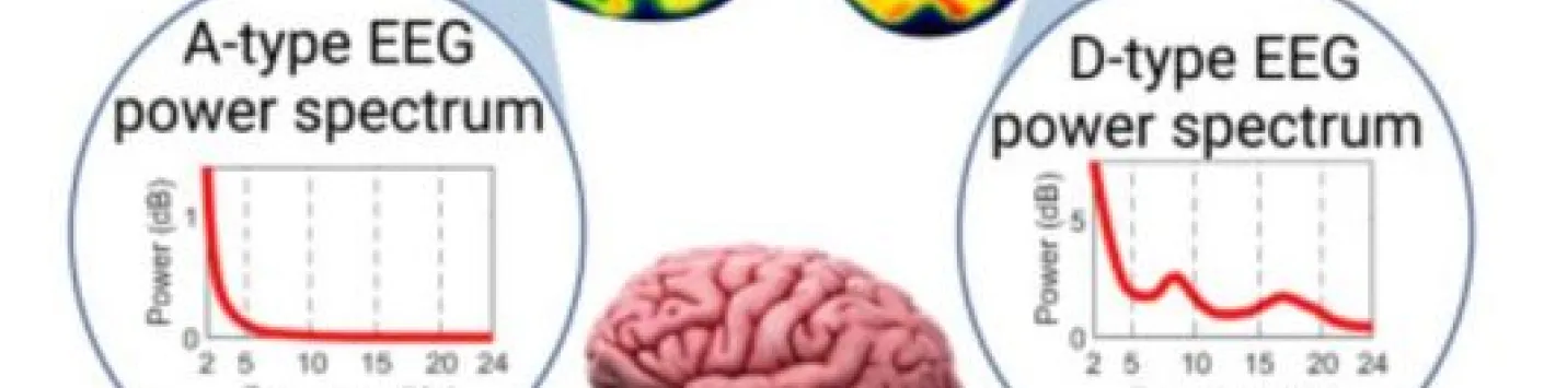 Couplage électrométabolique cérébral dans les états de conscience normaux et désordonnés